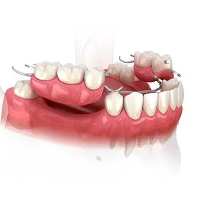 Partial Dentures at Carabelli Dental FL