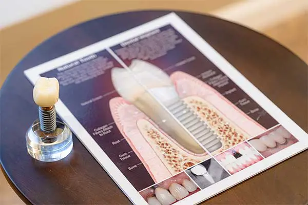 Dental Implants in Orlando, FL